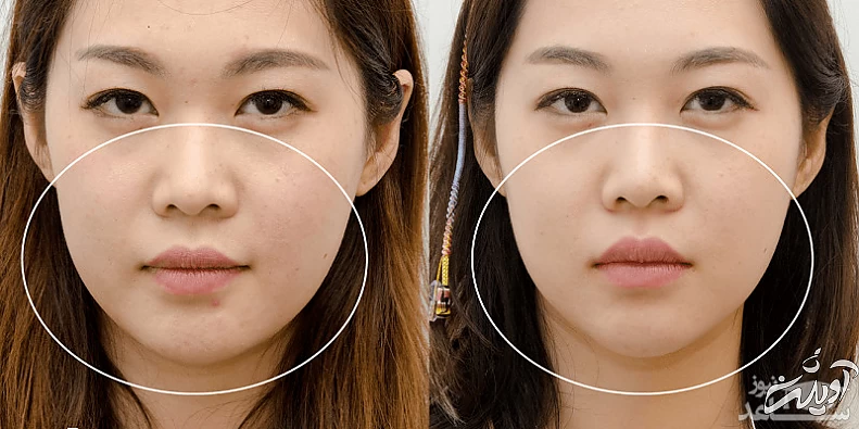 زاویه سازی صورت